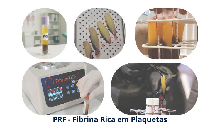 PRF - Fibrina Rica em Plaquetas PRF - Fibrina Rica em Plaquetas